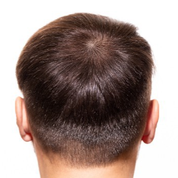 Mojoon hair loss after v1 350x350