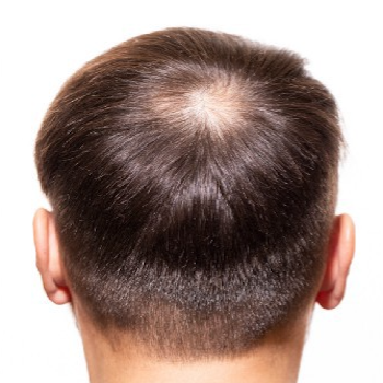 Mojoon hair loss before v1 350x350